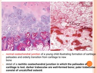 a. normal costochondral junction of a young child illustrating formation of cartilage
palisades and orderly transition from cartilage to new
bone
b. detail of a rachitic costochondral junction in which the palisades of
cartilage is lost. darker trabeculae are well-formed bone; paler trabeculae
consist of uncalcified osteoid.
 