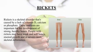 NUTRITIONAL DISORDERS AND PROTEIN ENERGY MALNUTRITION | PPTX