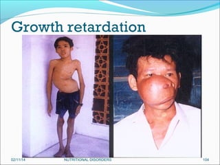 Growth retardation

02/11/14

NUTRITIONAL DISORDERS

104

 