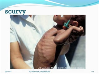 scurvy

02/11/14

NUTRITIONAL DISORDERS

111

 