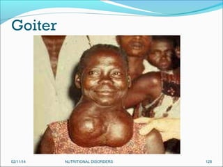 Goiter

02/11/14

NUTRITIONAL DISORDERS

128

 