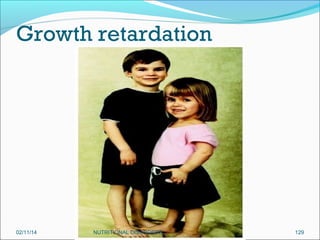 Growth retardation

02/11/14

NUTRITIONAL DISORDERS

129

 