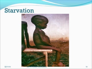 Starvation

02/11/14

NUTRITIONAL DISORDERS

14

 