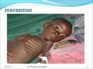 02/11/14

NUTRITIONAL DISORDERS

19

 