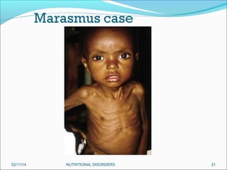 02/11/14

NUTRITIONAL DISORDERS

21

 