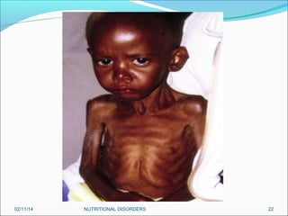 02/11/14

NUTRITIONAL DISORDERS

22

 