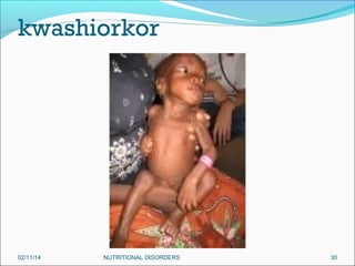 kwashiorkor

02/11/14

NUTRITIONAL DISORDERS

30

 