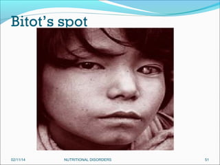 Bitot’s spot

02/11/14

NUTRITIONAL DISORDERS

51

 