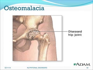 Osteomalacia

02/11/14

NUTRITIONAL DISORDERS

62

 