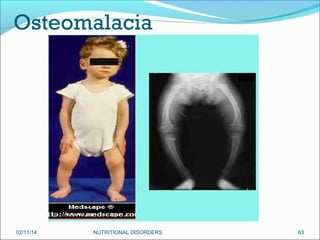 Osteomalacia

02/11/14

NUTRITIONAL DISORDERS

63

 