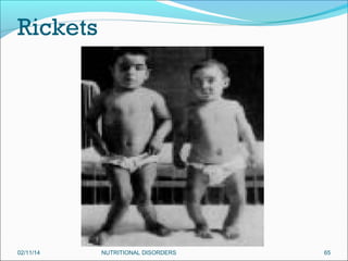 Rickets

02/11/14

NUTRITIONAL DISORDERS

65

 