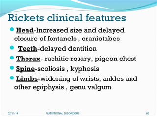 Rickets clinical features
Head-Increased size and delayed

closure of fontanels , craniotabes
 Teeth-delayed dentition
Thorax- rachitic rosary, pigeon chest
Spine-scoliosis , kyphosis
Limbs-widening of wrists, ankles and
other epiphysis , genu valgum

02/11/14

NUTRITIONAL DISORDERS

66

 