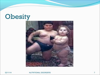 Obesity

02/11/14

NUTRITIONAL DISORDERS

7

 