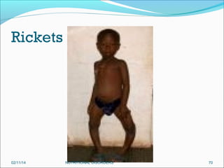 Rickets

02/11/14

NUTRITIONAL DISORDERS

70

 