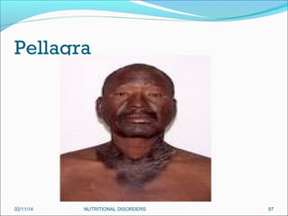 Pellagra

02/11/14

NUTRITIONAL DISORDERS

97

 