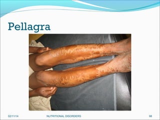Pellagra

02/11/14

NUTRITIONAL DISORDERS

98

 