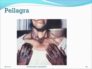 Pellagra

02/11/14

NUTRITIONAL DISORDERS

99

 
