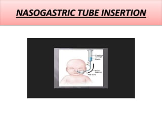 NASOGASTRIC TUBE INSERTION
 