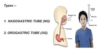 Types :-
1. NASOGASTRIC TUBE (NG)
2. OROGASTRIC TUBE (OG)
 