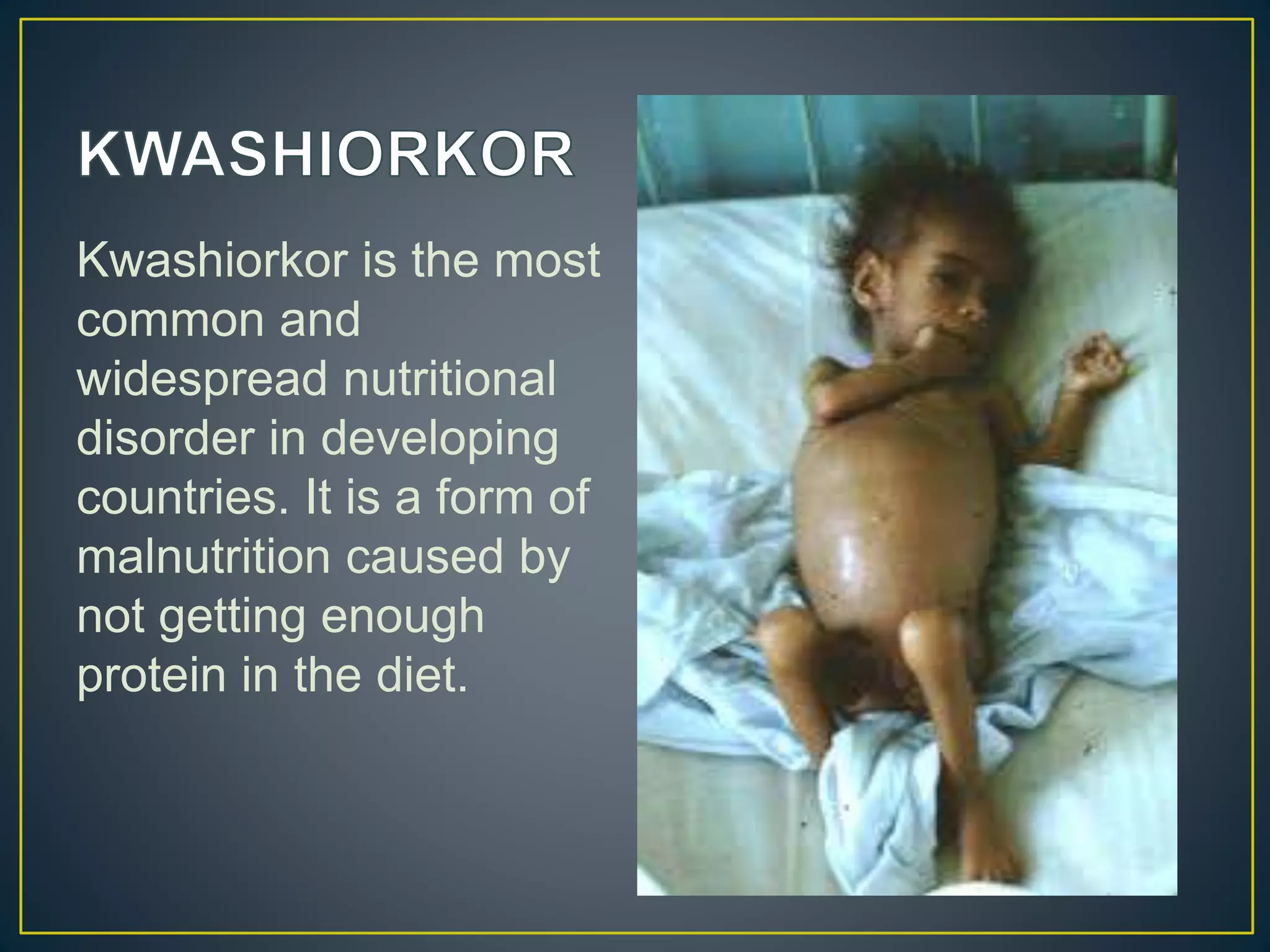 Kwashiorkor is the most
common and
widespread nutritional
disorder in developing
countries. It is a form of
malnutrition caused by
not getting enough
protein in the diet.
 