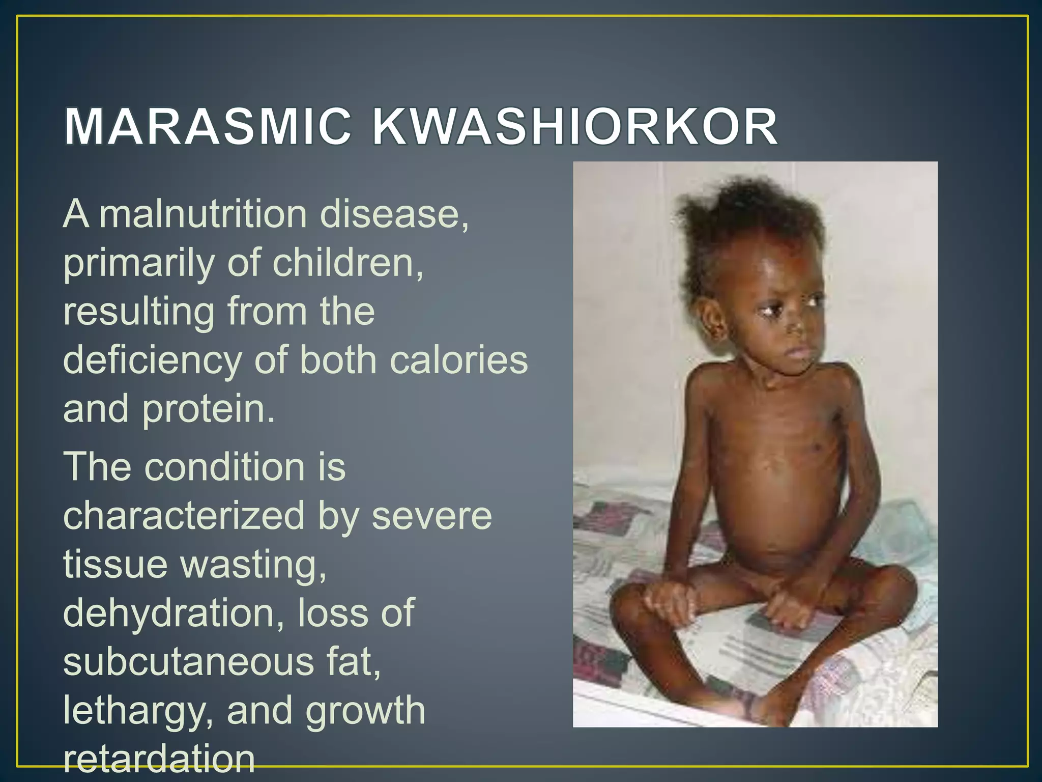 A malnutrition disease,
primarily of children,
resulting from the
deficiency of both calories
and protein.
The condition is
characterized by severe
tissue wasting,
dehydration, loss of
subcutaneous fat,
lethargy, and growth
retardation
 