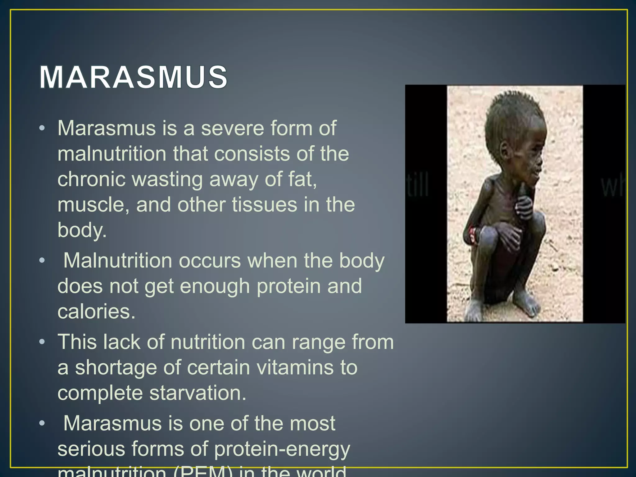 • Marasmus is a severe form of
malnutrition that consists of the
chronic wasting away of fat,
muscle, and other tissues in the
body.
• Malnutrition occurs when the body
does not get enough protein and
calories.
• This lack of nutrition can range from
a shortage of certain vitamins to
complete starvation.
• Marasmus is one of the most
serious forms of protein-energy
 