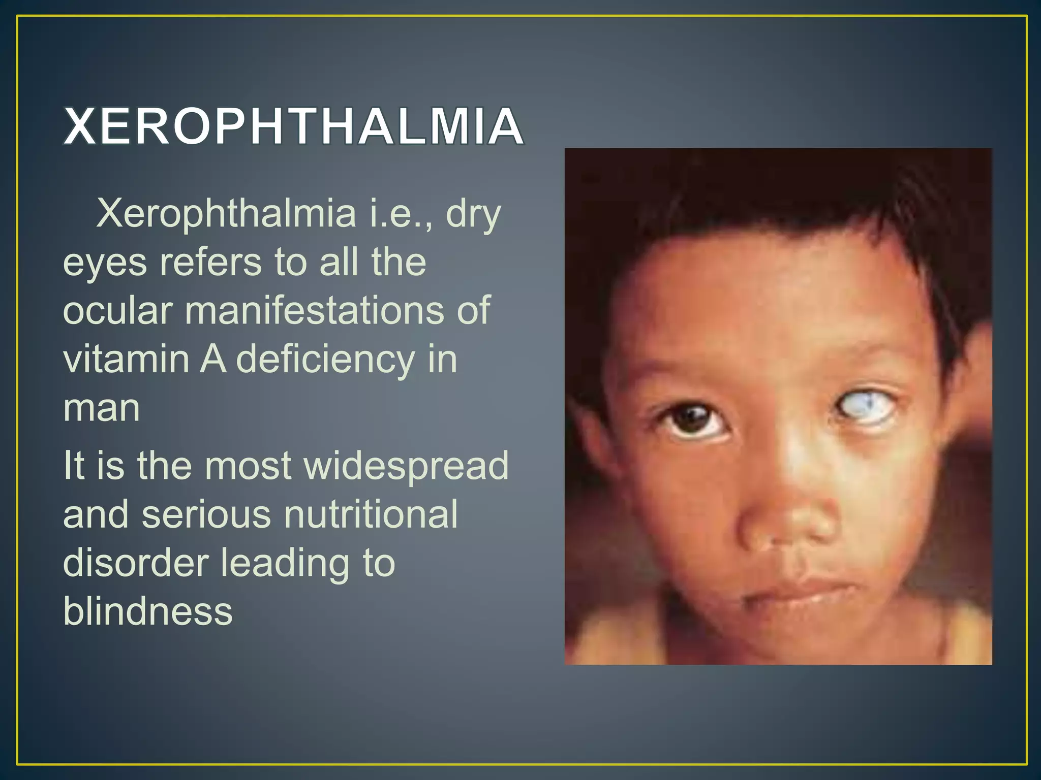 Xerophthalmia i.e., dry
eyes refers to all the
ocular manifestations of
vitamin A deficiency in
man
It is the most widespread
and serious nutritional
disorder leading to
blindness
 