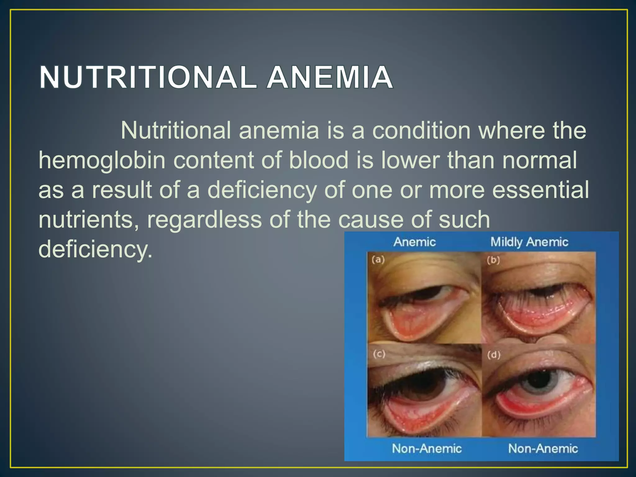 Nutritional anemia is a condition where the
hemoglobin content of blood is lower than normal
as a result of a deficiency of one or more essential
nutrients, regardless of the cause of such
deficiency.
 