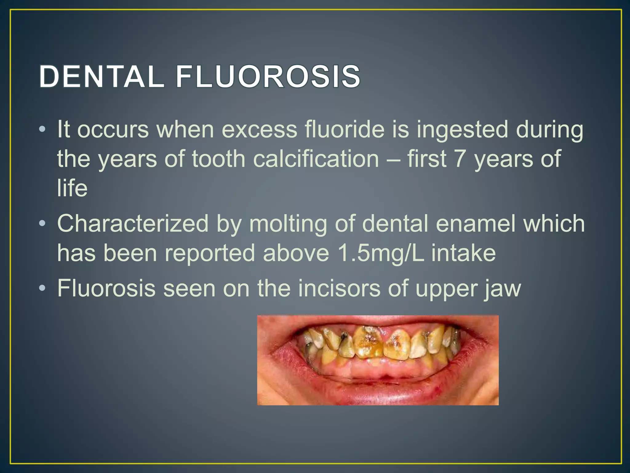 • It occurs when excess fluoride is ingested during
the years of tooth calcification – first 7 years of
life
• Characterized by molting of dental enamel which
has been reported above 1.5mg/L intake
• Fluorosis seen on the incisors of upper jaw
 