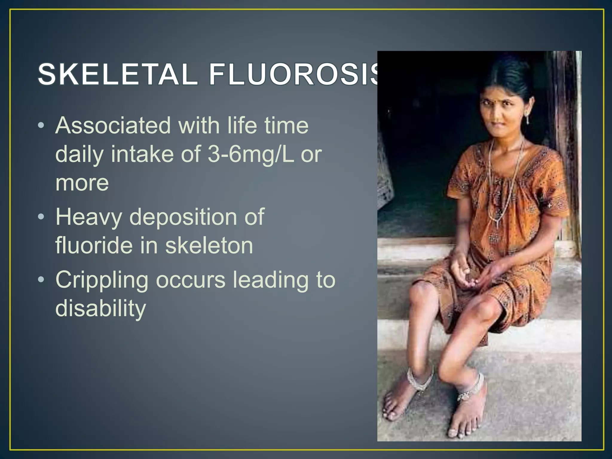 • Associated with life time
daily intake of 3-6mg/L or
more
• Heavy deposition of
fluoride in skeleton
• Crippling occurs leading to
disability
 