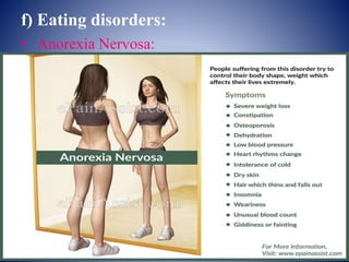 f) Eating disorders:
• Anorexia Nervosa:
 