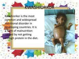 KWASHIORKOR
Kwashiorkor is the most
common and widespread
nutritional disorder in
developing countries. It is
a form of malnutrition
caused by not getting
enough protein in the diet.
 