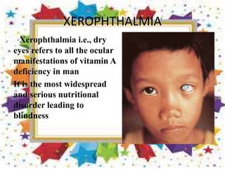 XEROPHTHALMIA
Xerophthalmia i.e., dry
eyes refers to all the ocular
manifestations of vitamin A
deficiency in man
It is the most widespread
and serious nutritional
disorder leading to
blindness
 