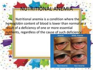 NUTRITIONAL ANEMIA
Nutritional anemia is a condition where the
hemoglobin content of blood is lower than normal as a
result of a deficiency of one or more essential
nutrients, regardless of the cause of such deficiency.
 