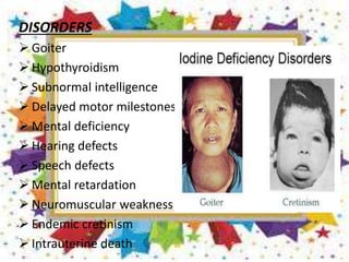 DISORDERS
 Goiter
 Hypothyroidism
 Subnormal intelligence
 Delayed motor milestones
 Mental deficiency
 Hearing defects
 Speech defects
 Mental retardation
 Neuromuscular weakness
 Endemic cretinism
 Intrauterine death
 