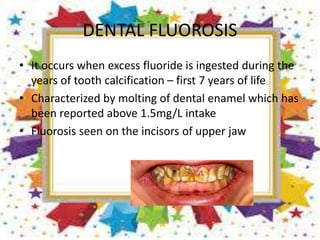 DENTAL FLUOROSIS
• It occurs when excess fluoride is ingested during the
years of tooth calcification – first 7 years of life
• Characterized by molting of dental enamel which has
been reported above 1.5mg/L intake
• Fluorosis seen on the incisors of upper jaw
 