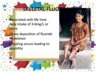 SKELETAL FLUOROSIS
• Associated with life time
daily intake of 3-6mg/L or
more
• Heavy deposition of fluoride
in skeleton
• Crippling occurs leading to
disability
 