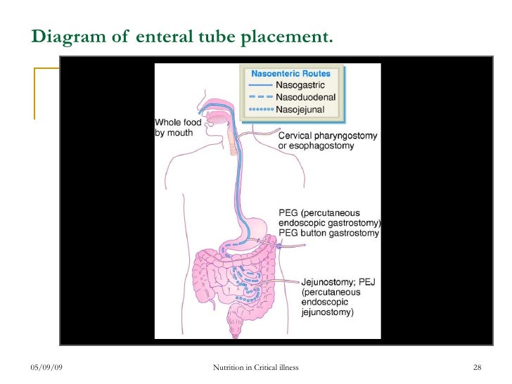 what is post- pyloric feeding what is post- pyloric feeding