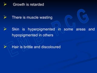  Growth is retarded
 There is muscle wasting
 Skin is hyperpigmented in some areas and
hypopigmented in others
 Hair is brittle and discoloured
 