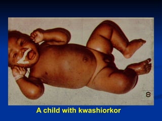 A child with kwashiorkor
 