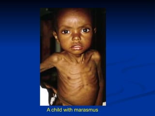 A child with marasmus
 
