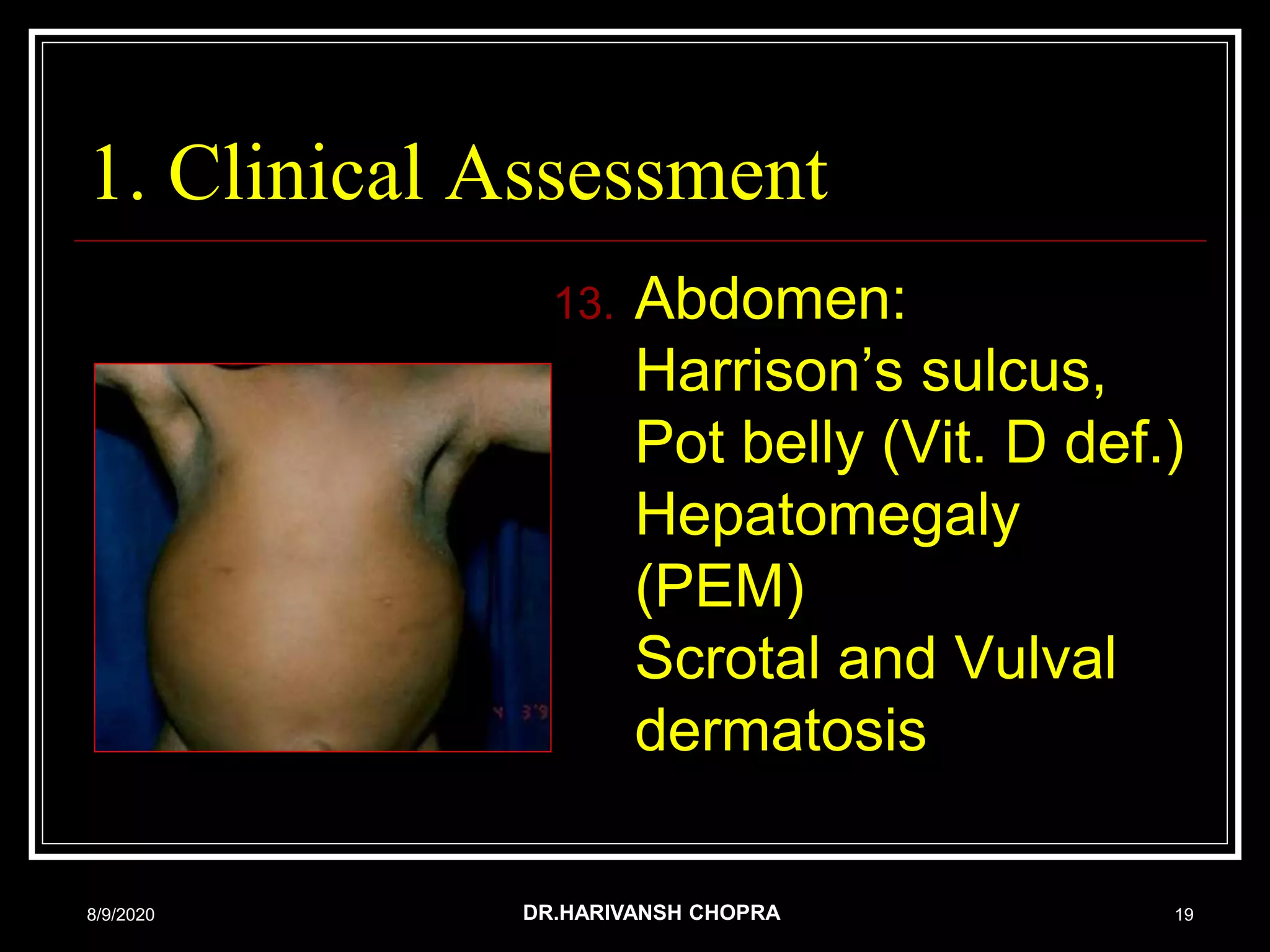 Nutrition assessment in children- dr harivansh chopra | PPT