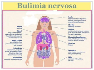 Bulimia nervosa
 