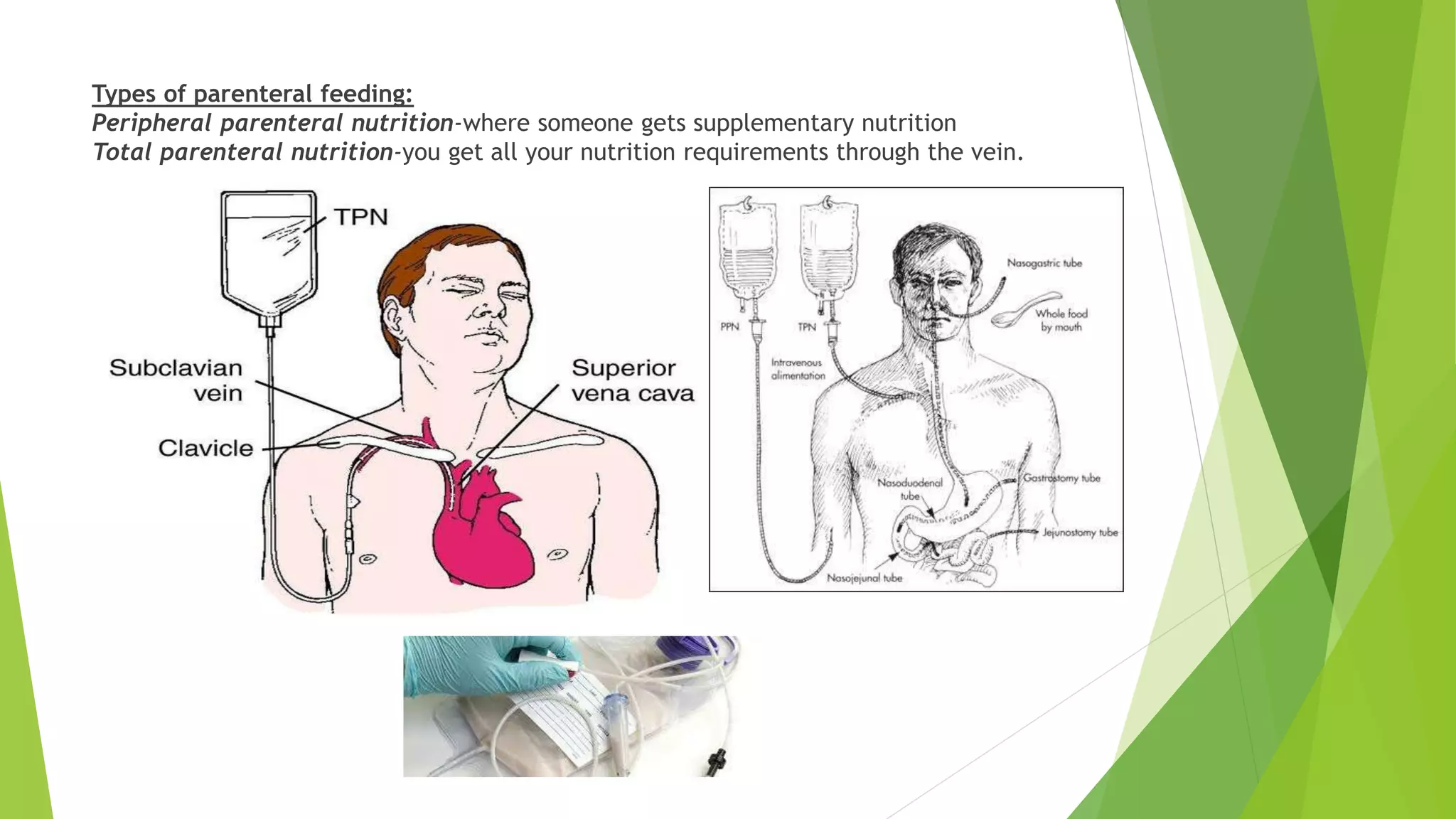 NUTRITION FEEDING MODES(parenteral ^0 enteral feeding).pptx