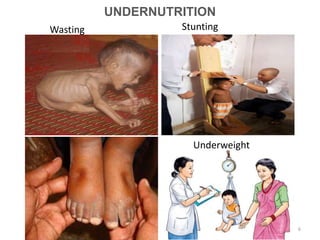 UNDERNUTRITION
StuntingWasting
Underweight
6
 