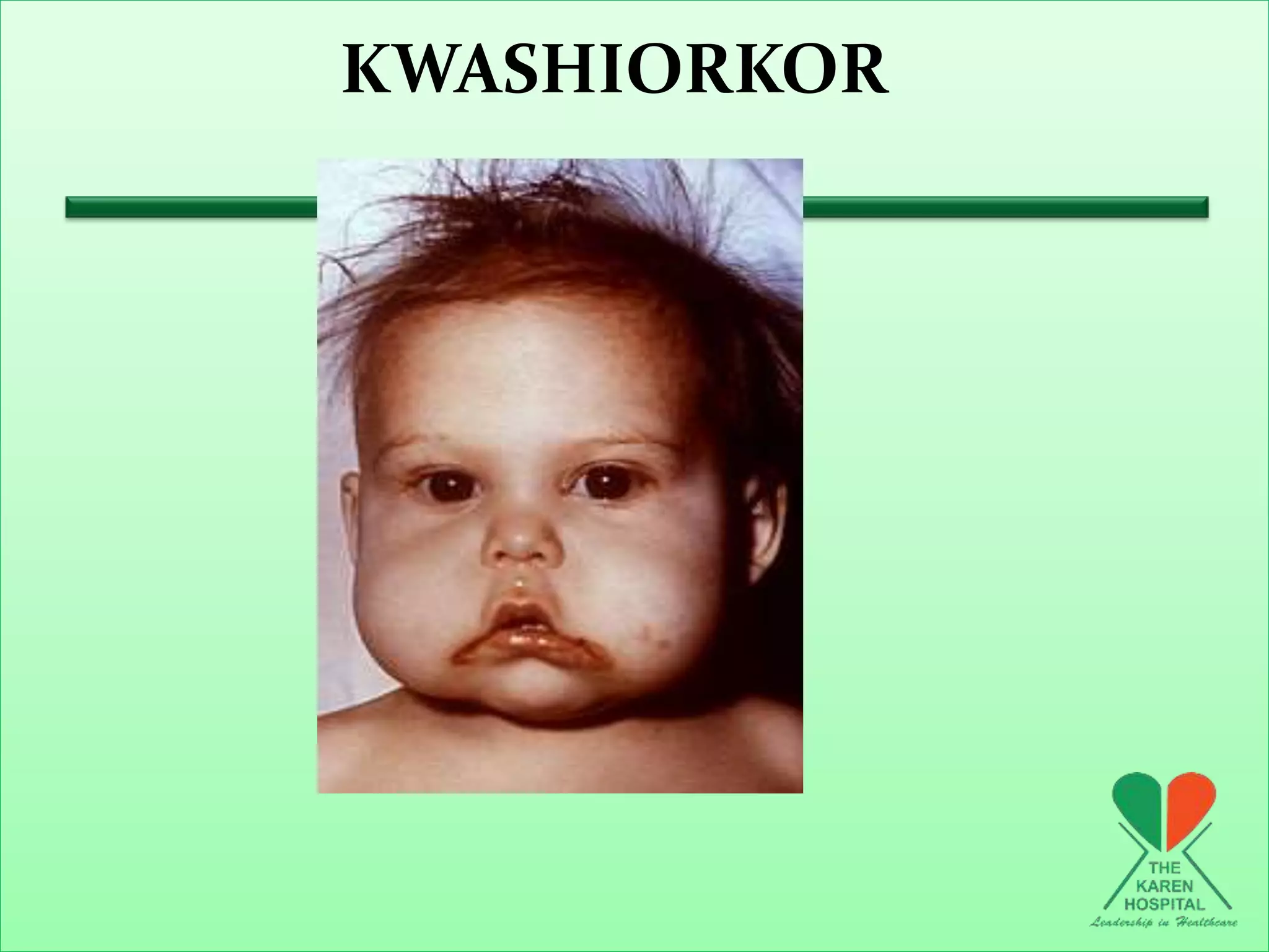 KWASHIORKOR
 