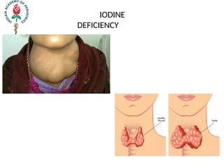 IODINE
DEFICIENCY
 