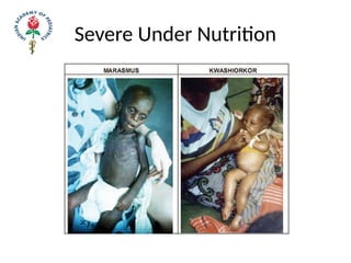 Severe Under Nutrition
 