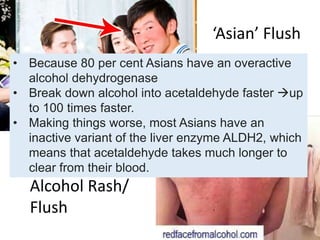 ‘Asian’ Flush
Alcohol Rash/
Flush
• Because 80 per cent Asians have an overactive
alcohol dehydrogenase
• Break down alcohol into acetaldehyde faster up
to 100 times faster.
• Making things worse, most Asians have an
inactive variant of the liver enzyme ALDH2, which
means that acetaldehyde takes much longer to
clear from their blood.
 