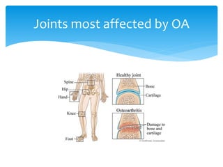 Nutrition management for osteoarthritis (oa) | PPTX